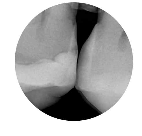 Enlarged DC-Air™ bitewing showing interproximal radiolucent detail between the premolars