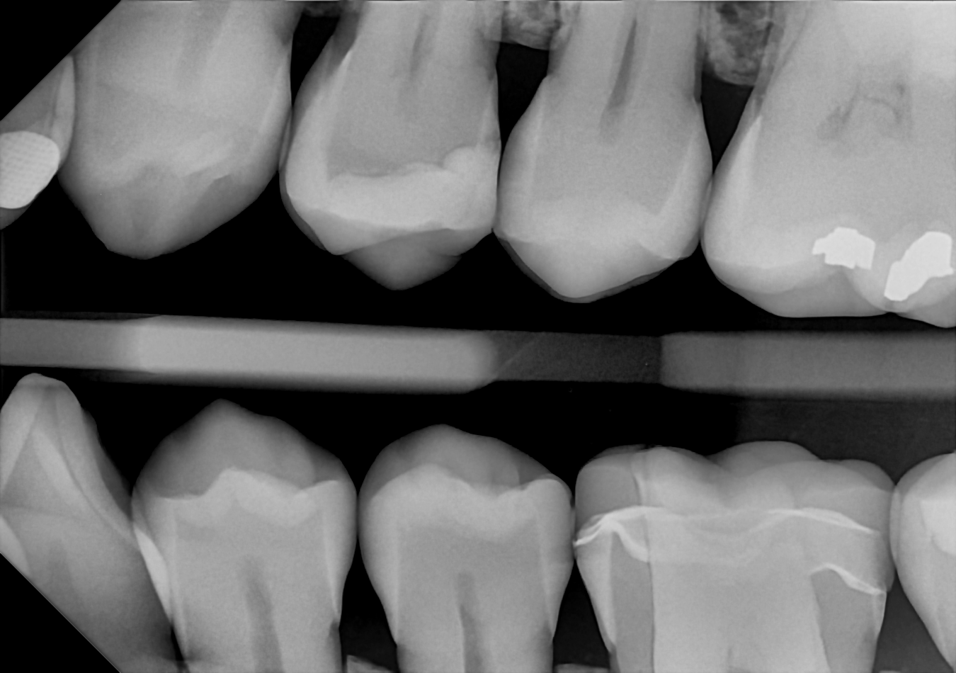 DC-Air™ premolar bitewing with mesial positioning and the full sensor frame visible