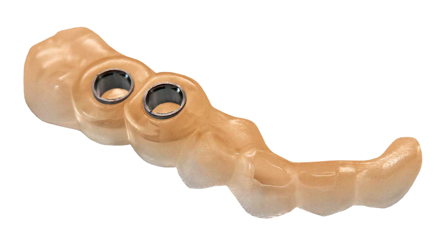A tan 3D-printed surgical guide shaped to the lower arch with two metal sleeve inserts for guided implant drilling