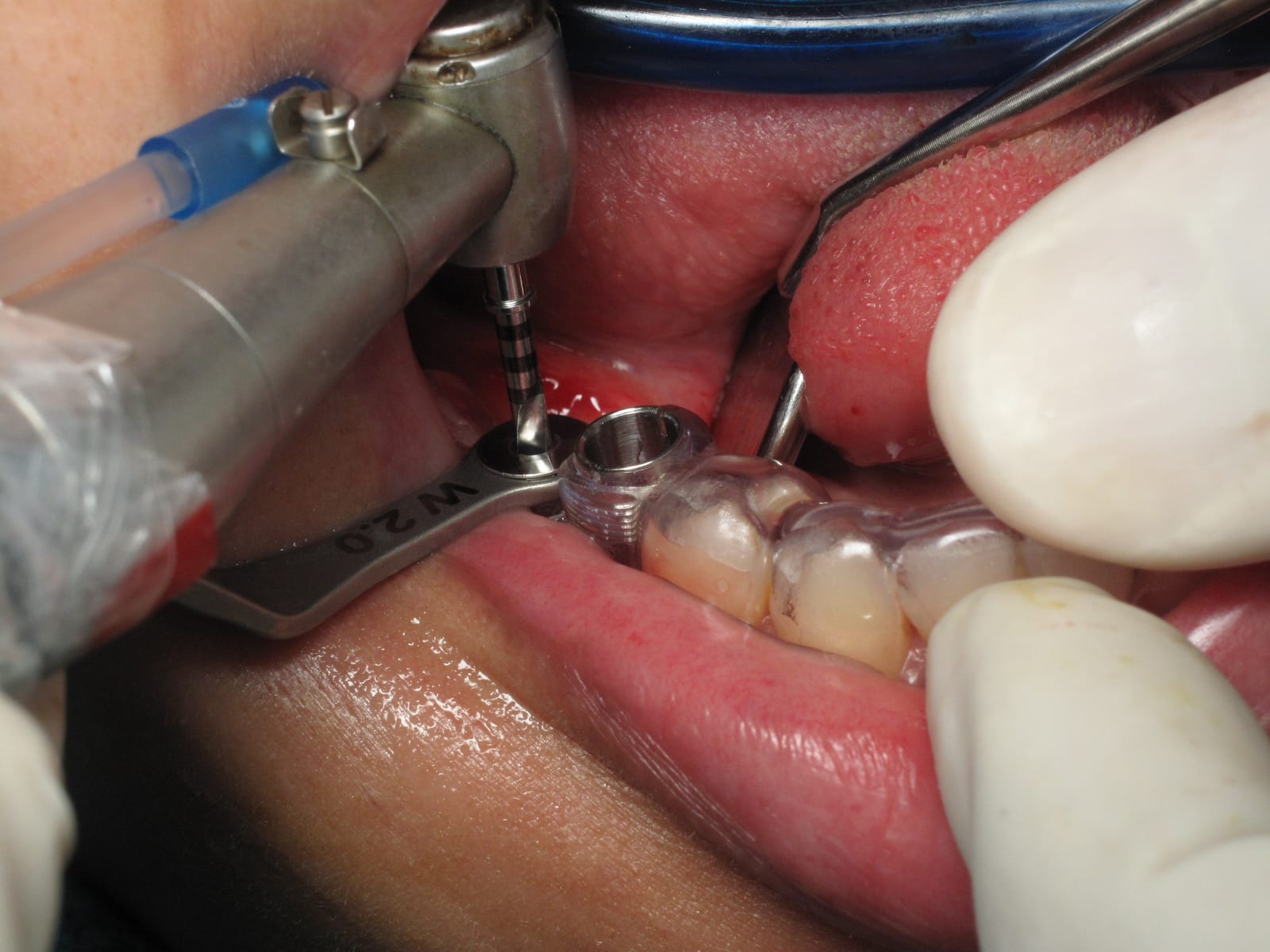 Close-up of a dental implant placement in progress, showing a wrench driver seated on an implant next to a surgical guide in the patient's mouth