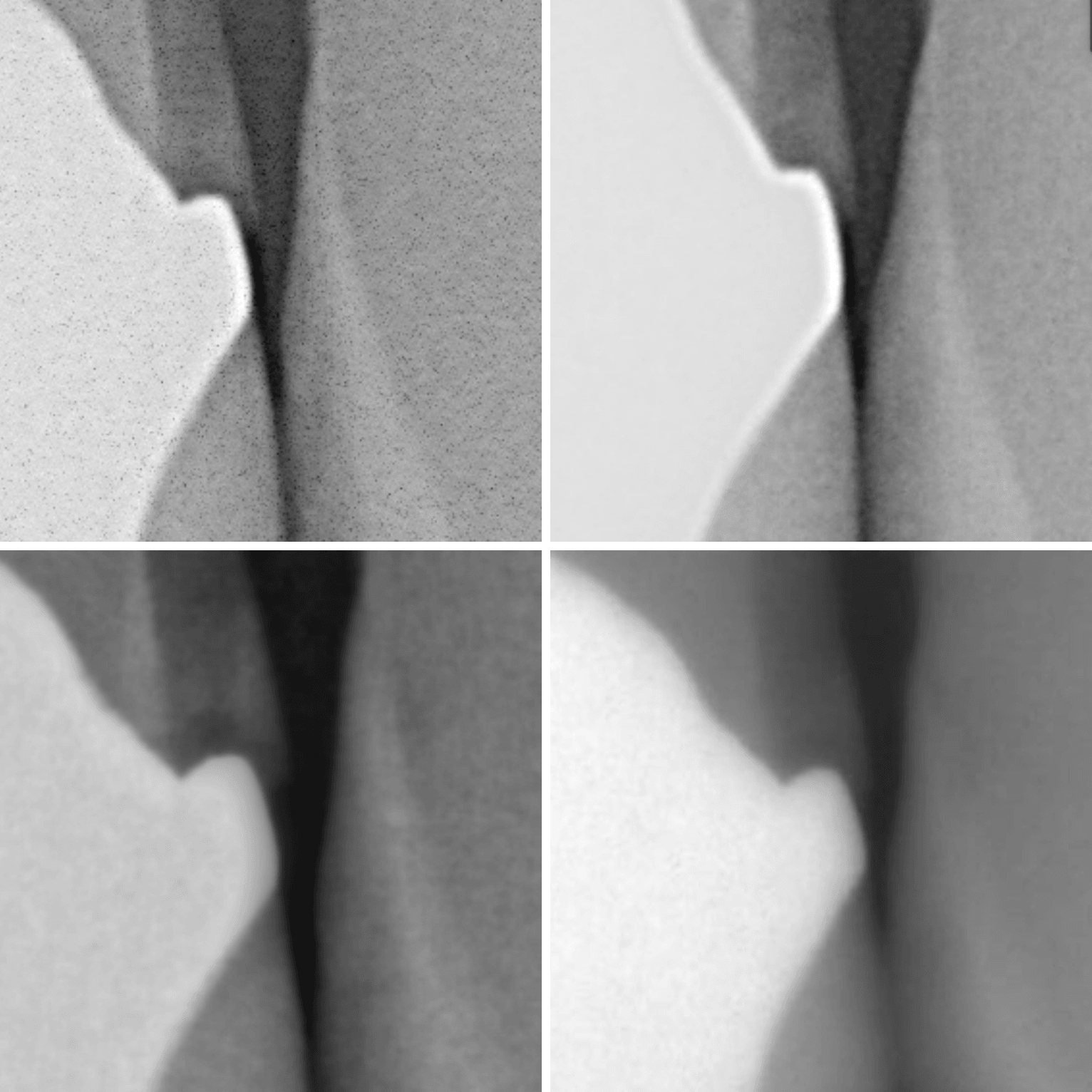 Four x-rays zoomed to show close-up decay. All four are different resolutions with filters applied.