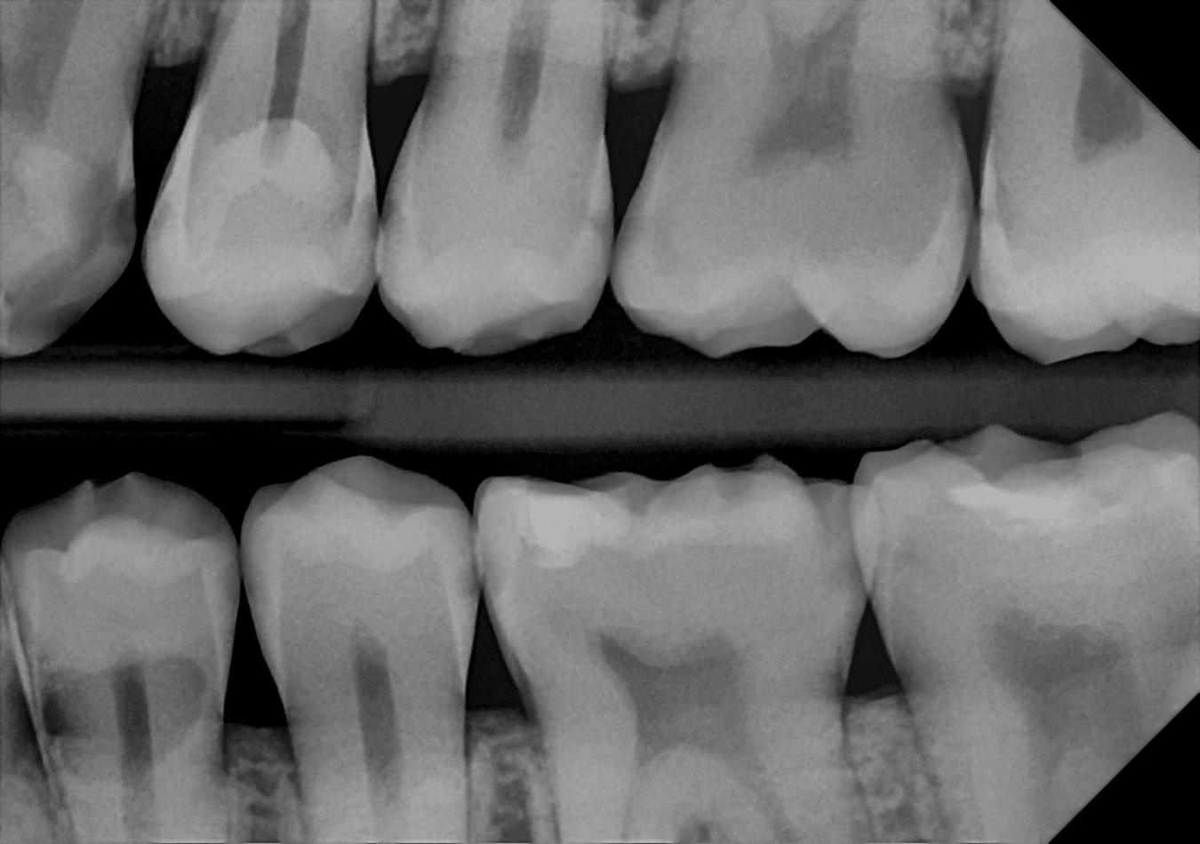 DC-Air direct conversion Dental bitewing X-ray showing upper and lower molars and premolars in grayscale, with a dark gap between the teeth rows.