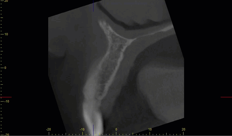 Animated close-up sagittal CBCT scroll showing the root canal running from mid-root to the apex