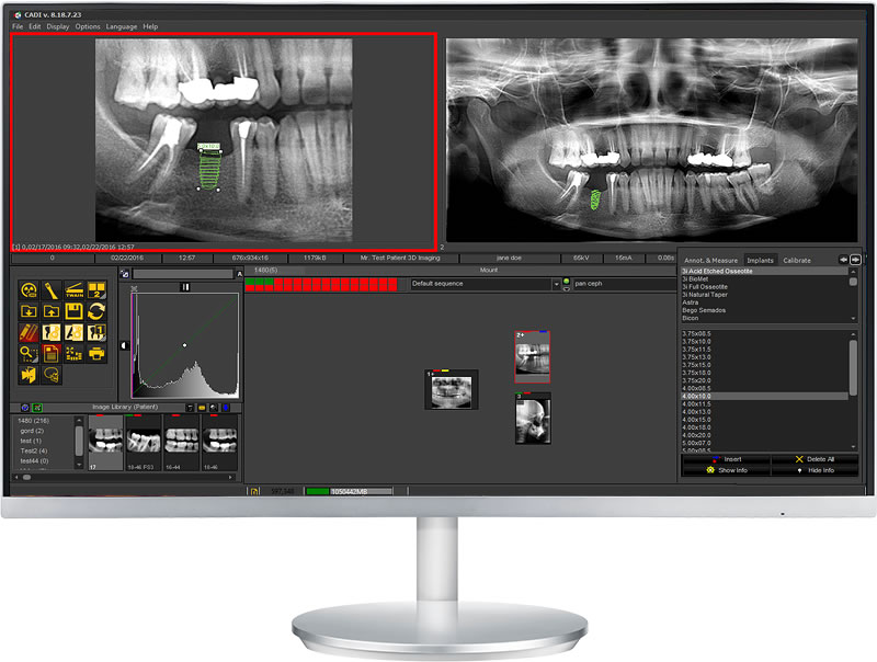 Implant planning module in CADI