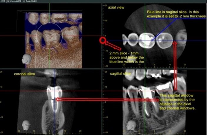 Four-panel CBCT viewer showing a 3D tooth volume, axial view, coronal slice, and sagittal slice with red annotations marking a 2mm slice thickness and its corresponding sagittal window