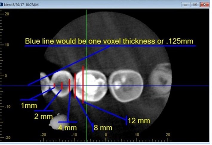 Annotated axial CBCT slice through a row of teeth with blue and red lines marking voxel thickness measurements from 1mm up to 12mm