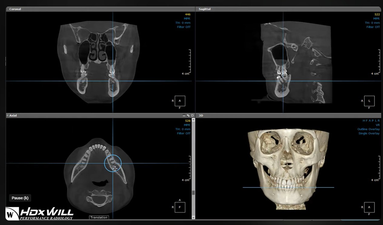 HDX Will Master Software Illustrates 3D Volume