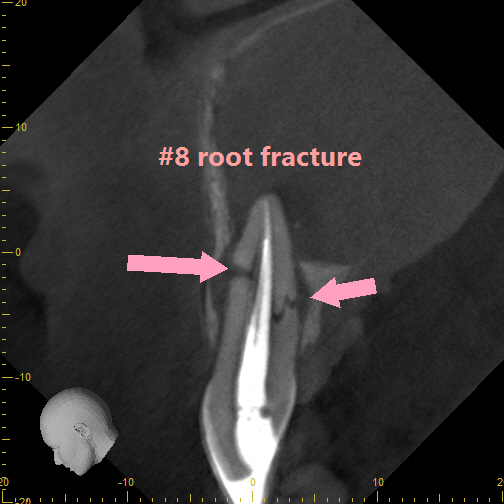 A Sagittal Slice from A CBCT Volume Shows a Root Fracture