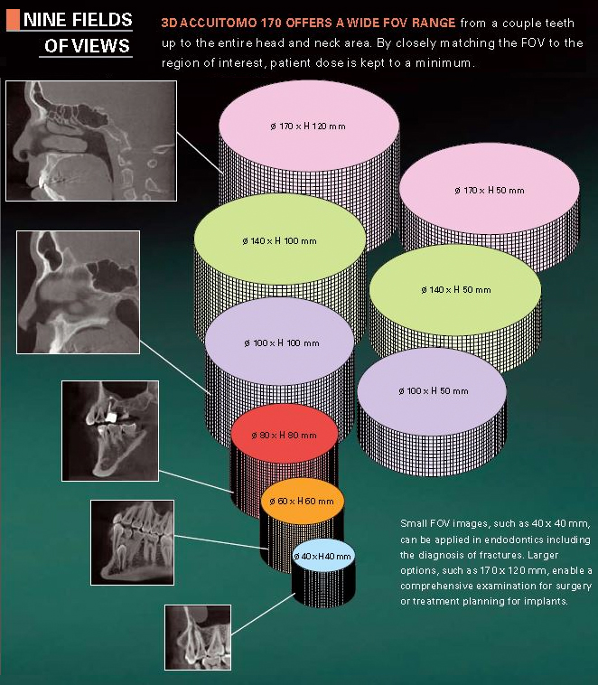 Infographic of the J. Morita 3D Accuitomo 170’s nine field-of-view sizes, shown as nested cylinders from 40x40mm to 170x120mm each paired with a sample scan image