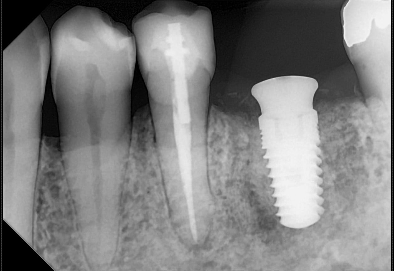 A DC-Air direct-conversion periapical showing a root-canal-treated tooth next to a threaded dental implant, with bone trabeculation visible in close contact along the implant threads.