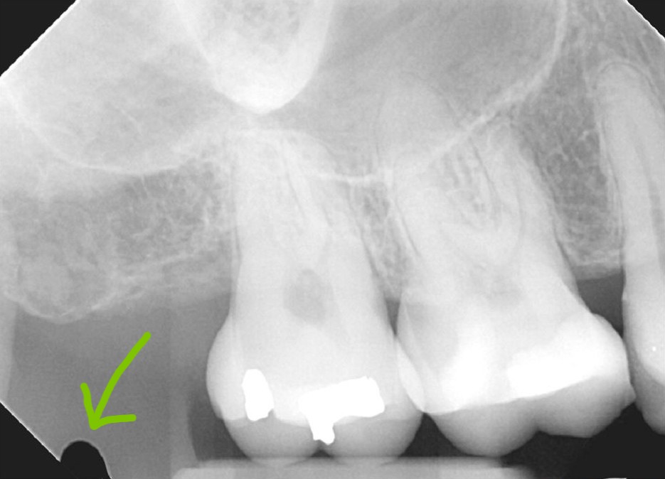 An example of delamination artifact on a digital radiograph. Delamination artifact is caused by the scintillating layer of conventional x-ray sensors separating from the photosensitive detector. By evaporating the scintillating crystals directly to the detector, PrimeView™ Ultra protects against non-repairable delamination.