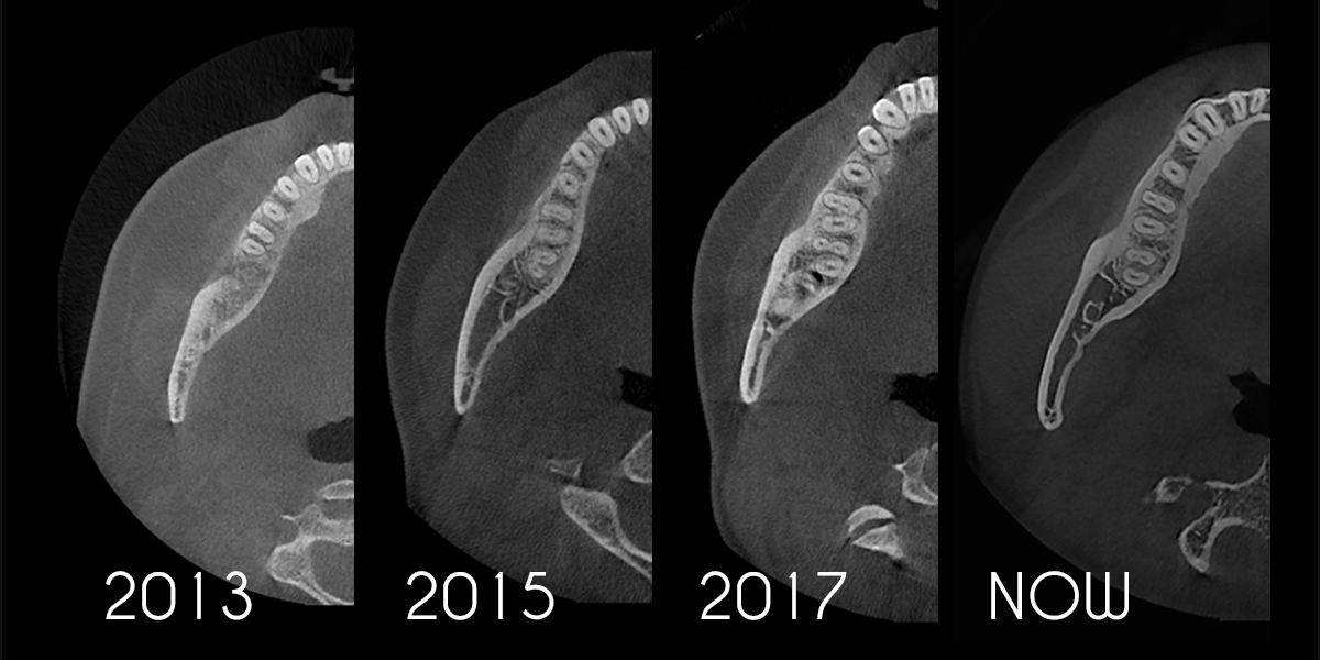 Example of HDX Will’s Cyoptix algorithm improvements over time.