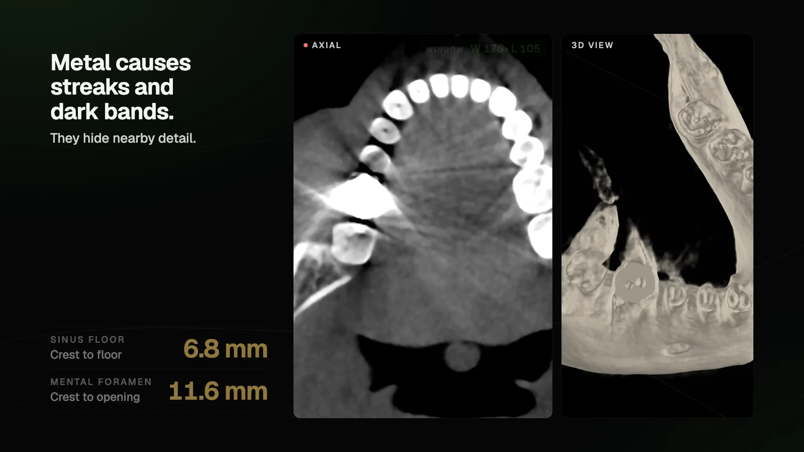 An axial CBCT slice through a metal crown, with the streaks and a dark band labeled under a narrowed window