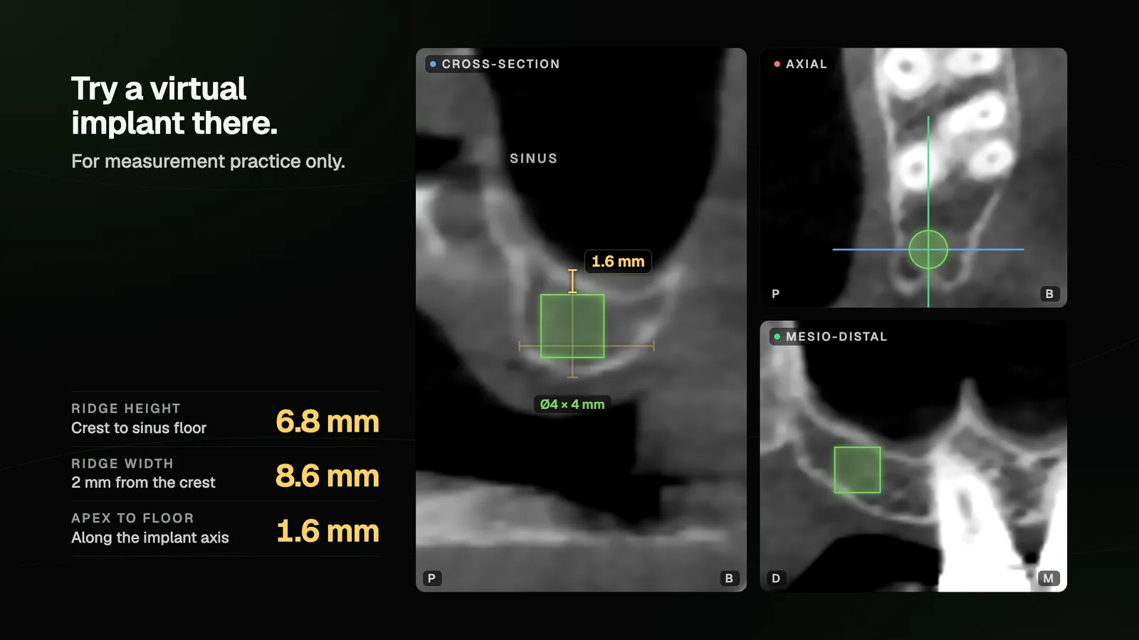 A virtual 4 × 4 mm implant on a CBCT cross-section, with ridge height 6.8 mm, ridge width 8.6 mm and 1.6 mm from apex to sinus floor