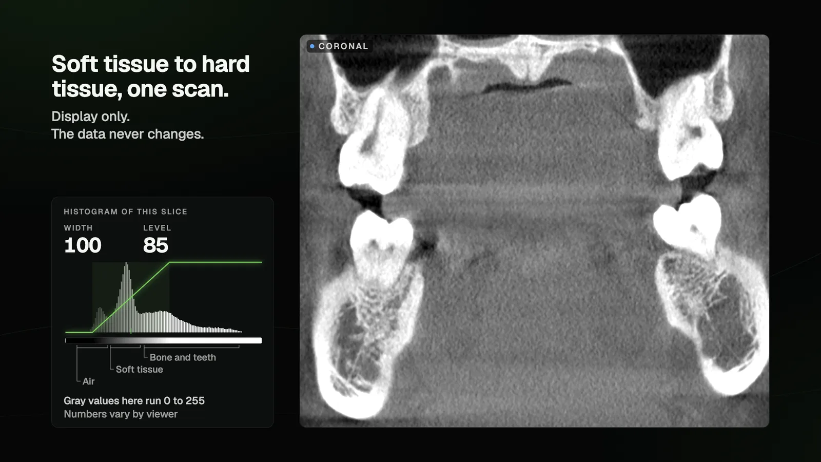 A coronal CBCT slice under a soft-tissue window, with a histogram showing where air, soft tissue, and bone and teeth fall