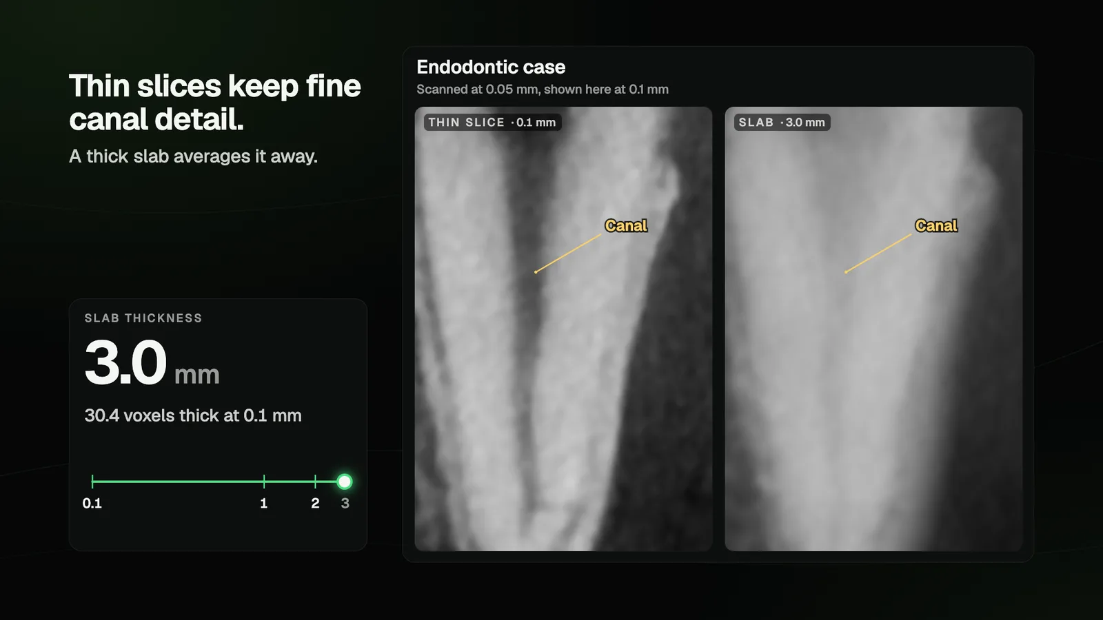 The same root in an endodontic CBCT at a 0.1 mm slice, where the canal is visible, and at a 3 mm slab, where it averages away