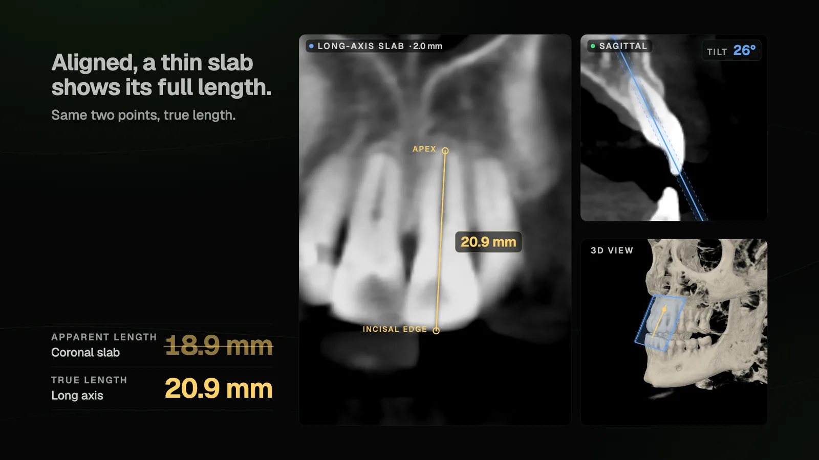 The same incisor measured 18.9 mm on an oblique coronal slab and 20.9 mm on a slab aligned with its long axis