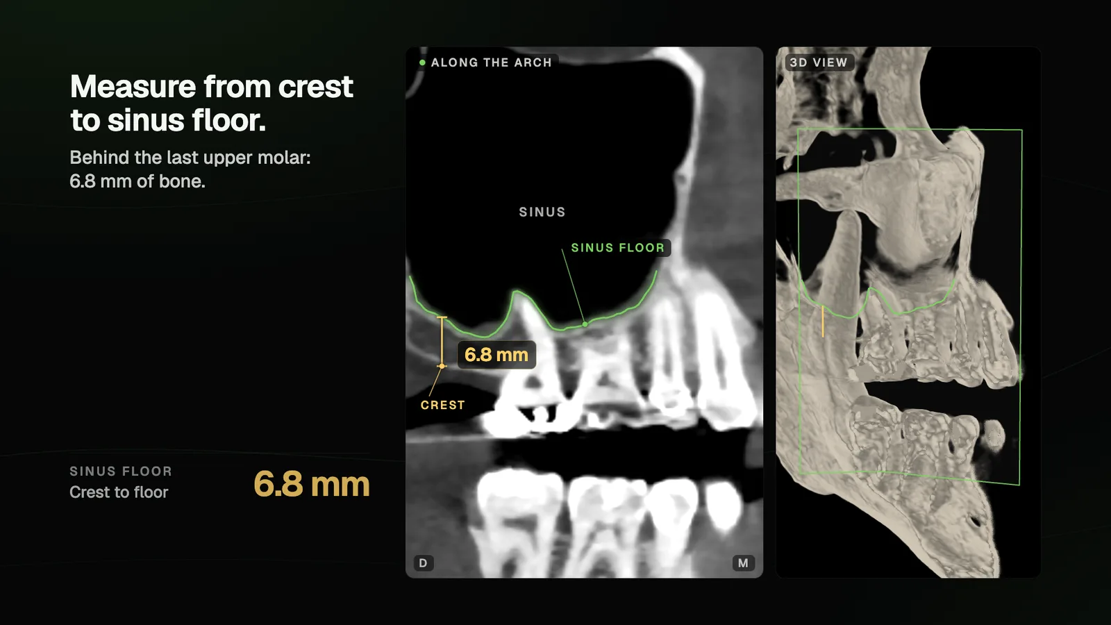 A curved CBCT slice along the upper posterior teeth with the sinus floor traced and 6.8 mm measured from crest to floor behind the last molar