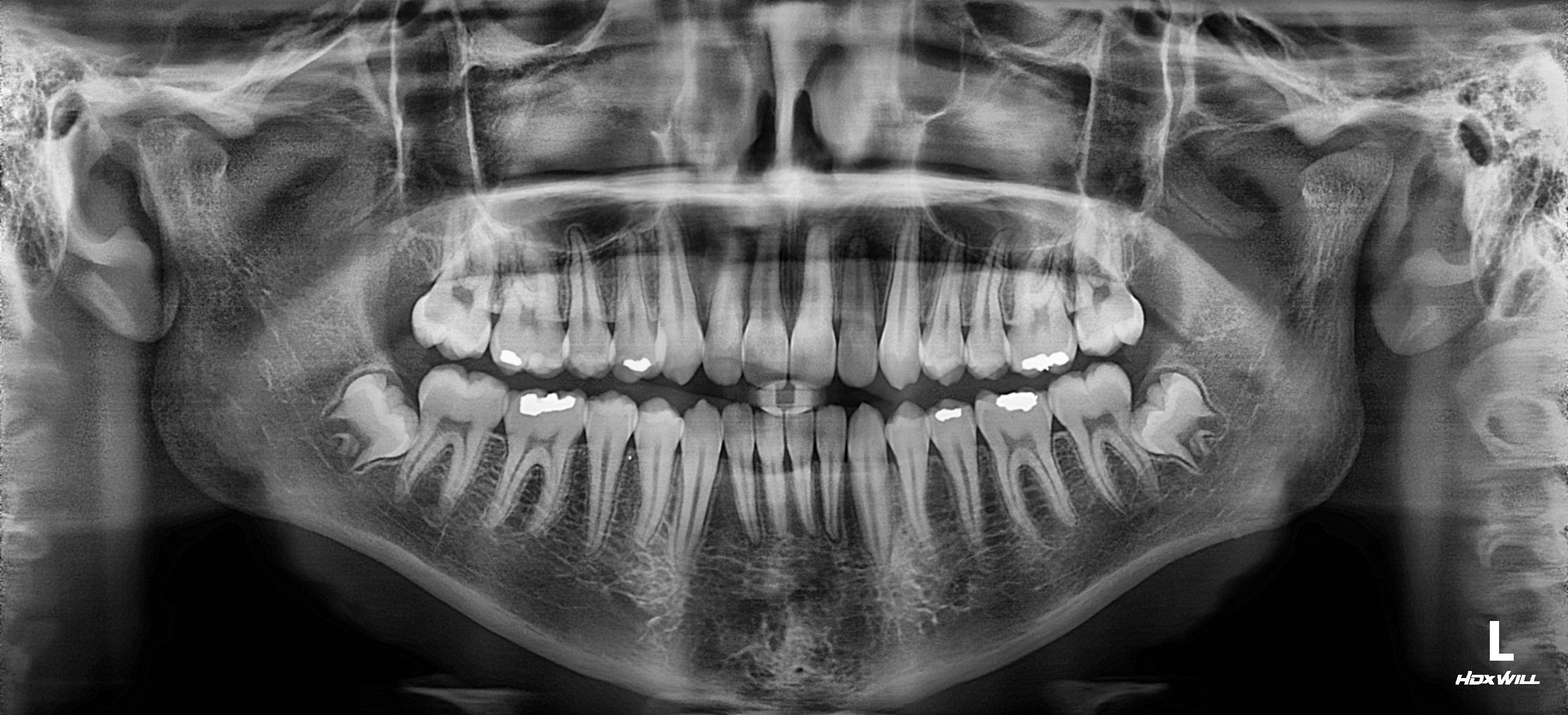 HDX Will Example Panoramic Radiograph