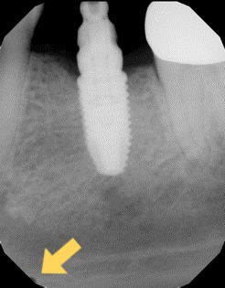 Example of early delamination artifact in scintillating x-ray sensor.