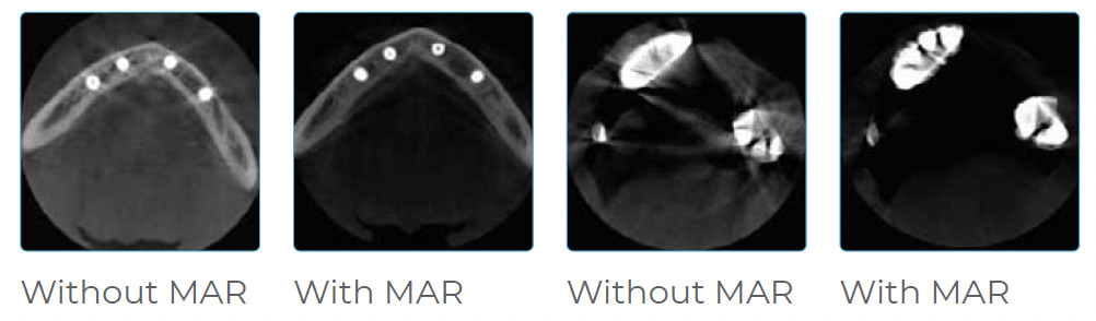Official PreXion Metal Artifact Reduction examples, shown without MAR and with MAR