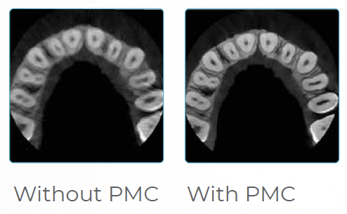 Official PreXion Patient Motion Correction comparison, shown without correction and with correction
