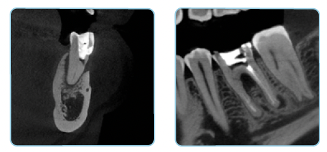 PreXion comparison illustrating the image-detail difference between a conventional 0.5 mm focal spot and the Excelsior Endo's 0.2 mm focal spot