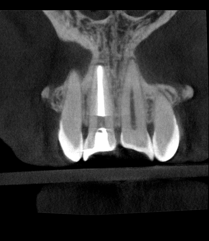Coronal view of an endodontically treated anterior tooth