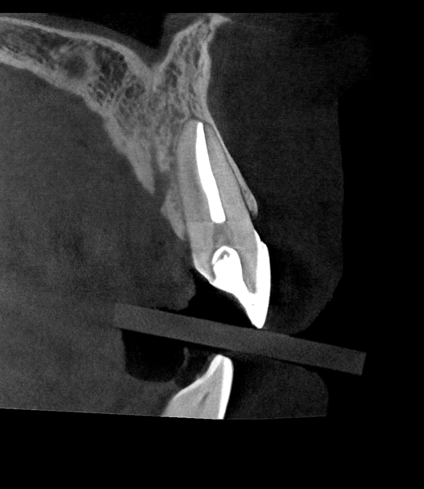 Sagittal view of an endodontically treated anterior tooth