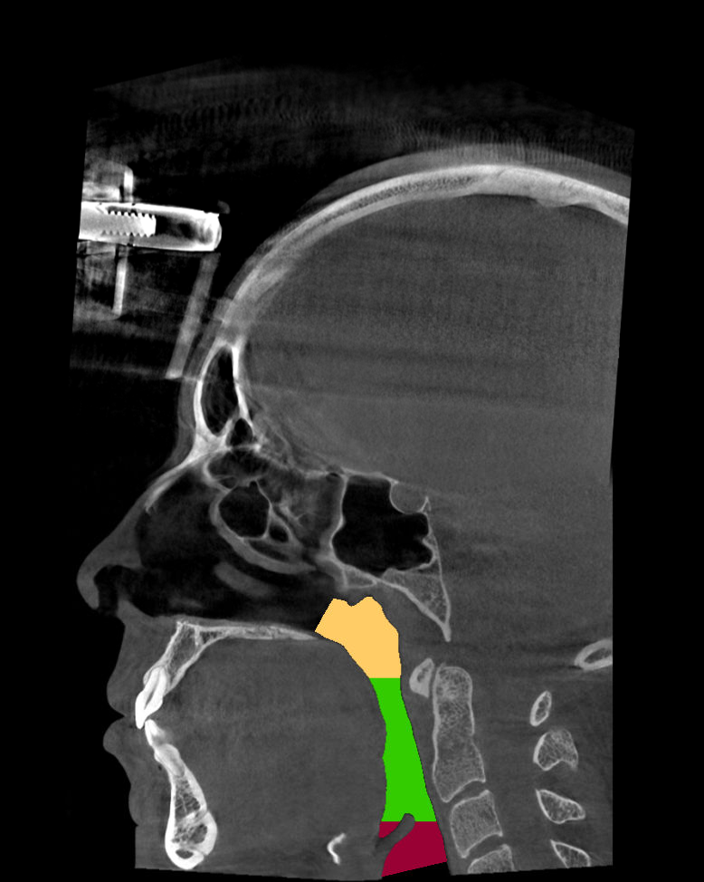 Sagittal airway view with source color overlay