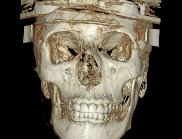Frontal 3D reconstruction from a full-face assessment
