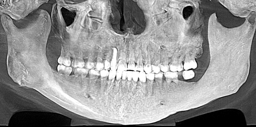 Panoramic MIP from a full-face assessment