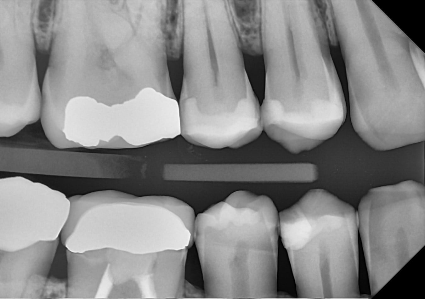 A DC-Air direct-conversion cuspid bitewing showing crisp crown margins, contacts, and enamel detail in the premolar region.