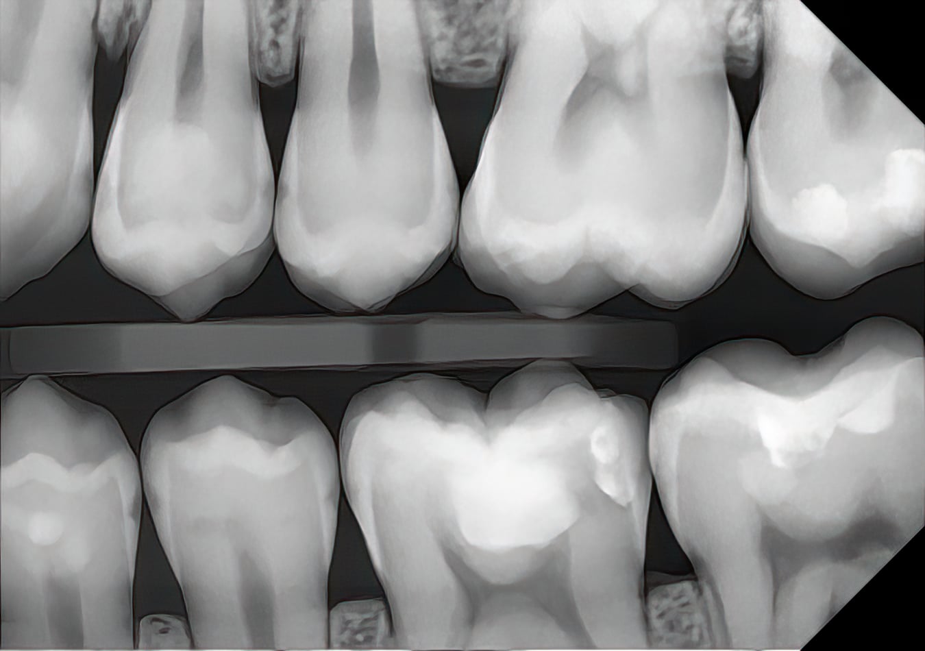 Unfiltered DC-Air posterior bitewing radiograph at high magnification, enamel and dentin detail