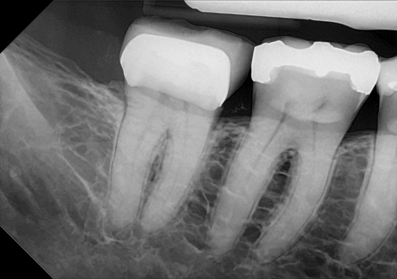A DC-Air direct-conversion lower posterior periapical showing two crowned teeth with crisp root, canal, and alveolar bone trabeculation detail.