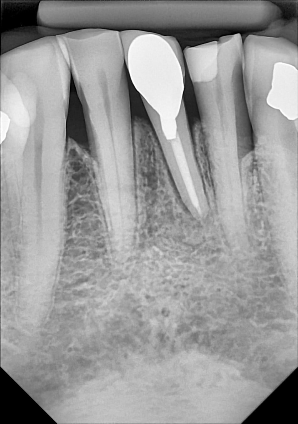 DC-Air lower anterior periapical from the Dental TI clinical image gallery